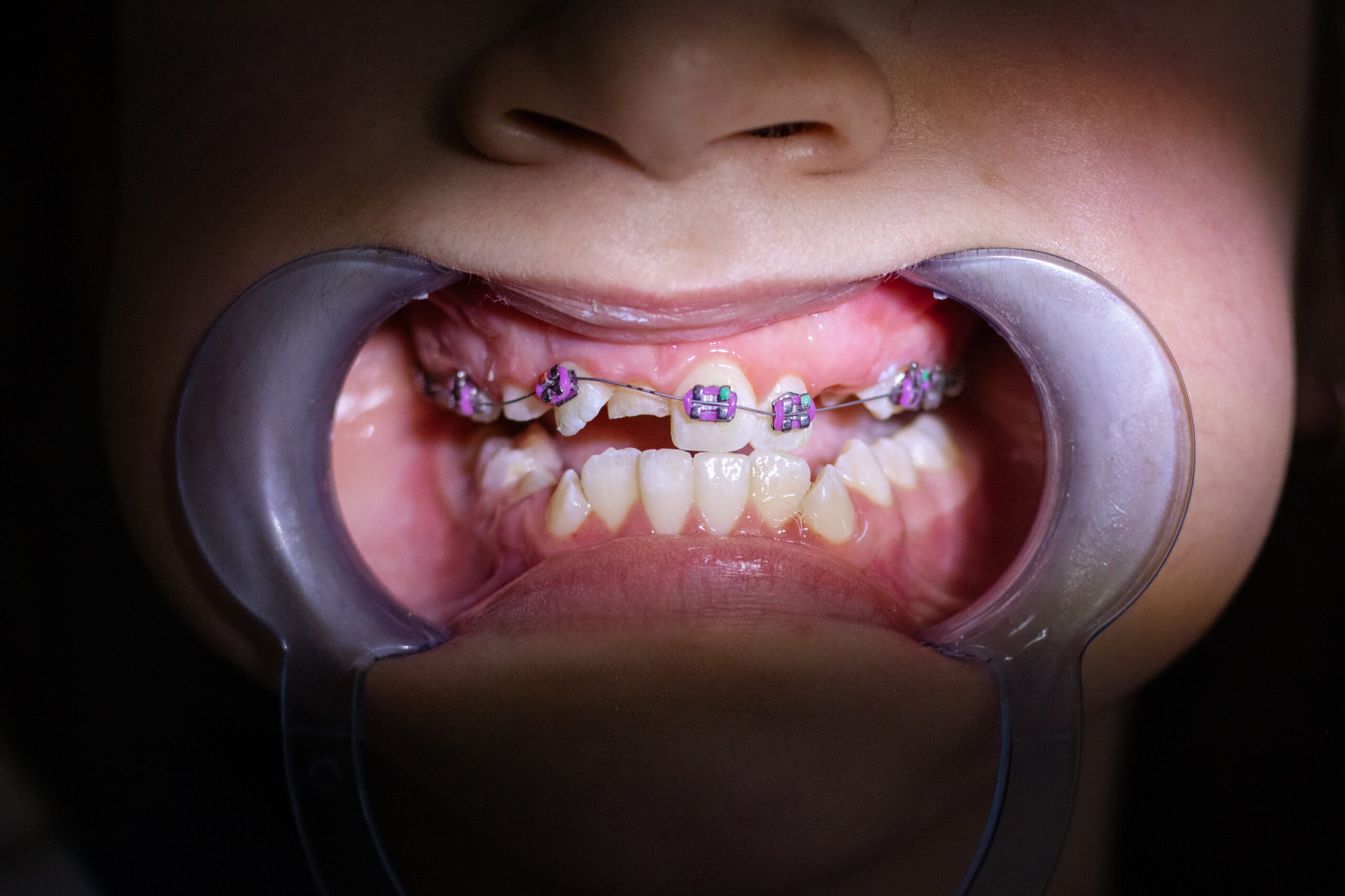 Brackets colocados en los dientes anteriores